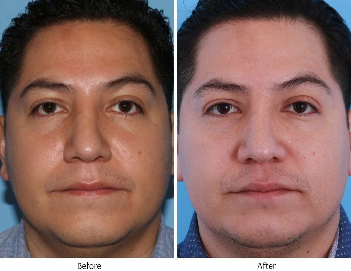 Revision Rhinoplasty Before & After Gallery - Patient 64081003 - Image 3