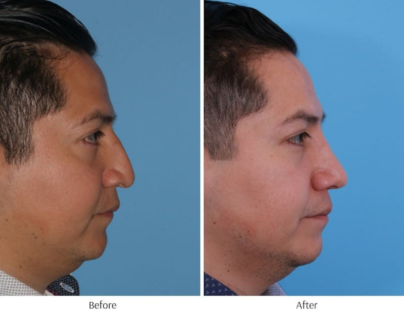 Revision Rhinoplasty Before & After Gallery - Patient 64081003 - Image 1