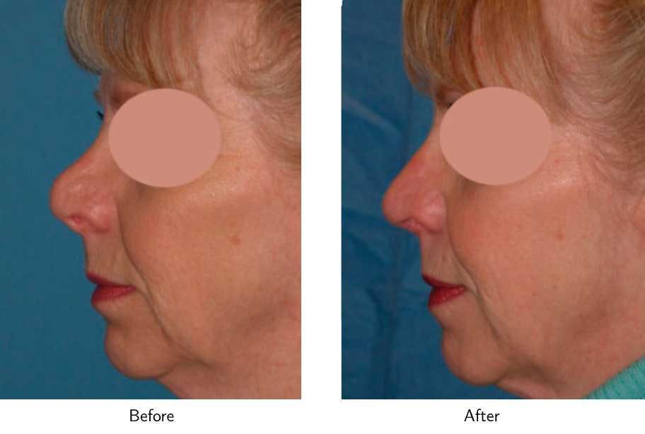 Revision Rhinoplasty Before & After Gallery - Patient 64081004 - Image 3
