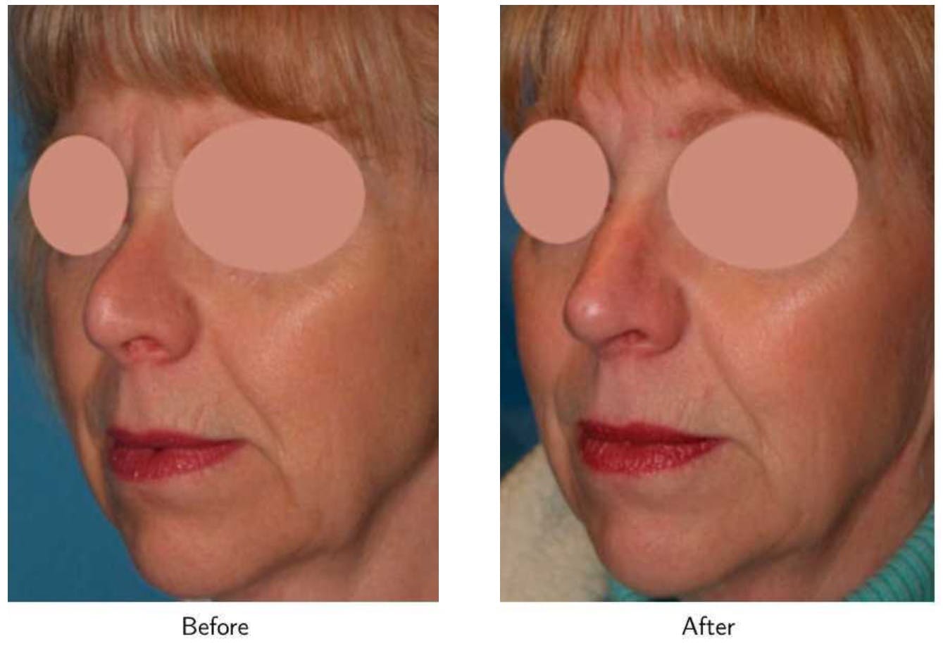Revision Rhinoplasty Before & After Gallery - Patient 64081004 - Image 2