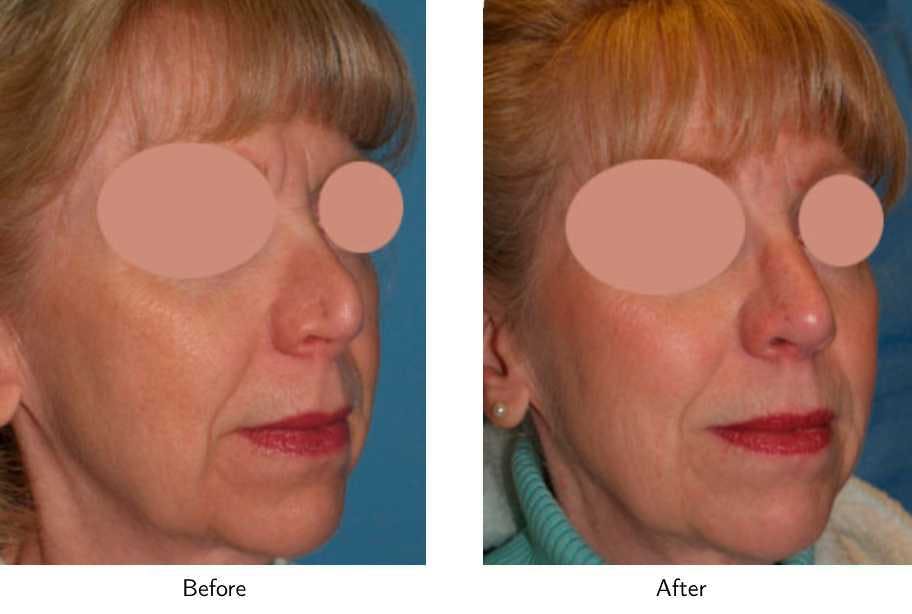 Revision Rhinoplasty Before & After Gallery - Patient 64081004 - Image 4
