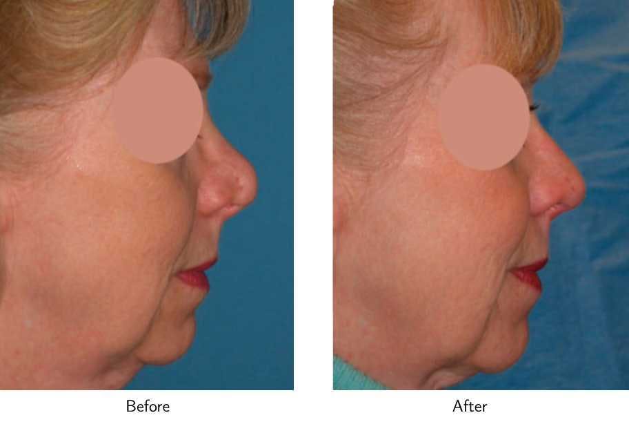 Revision Rhinoplasty Before & After Gallery - Patient 64081004 - Image 1