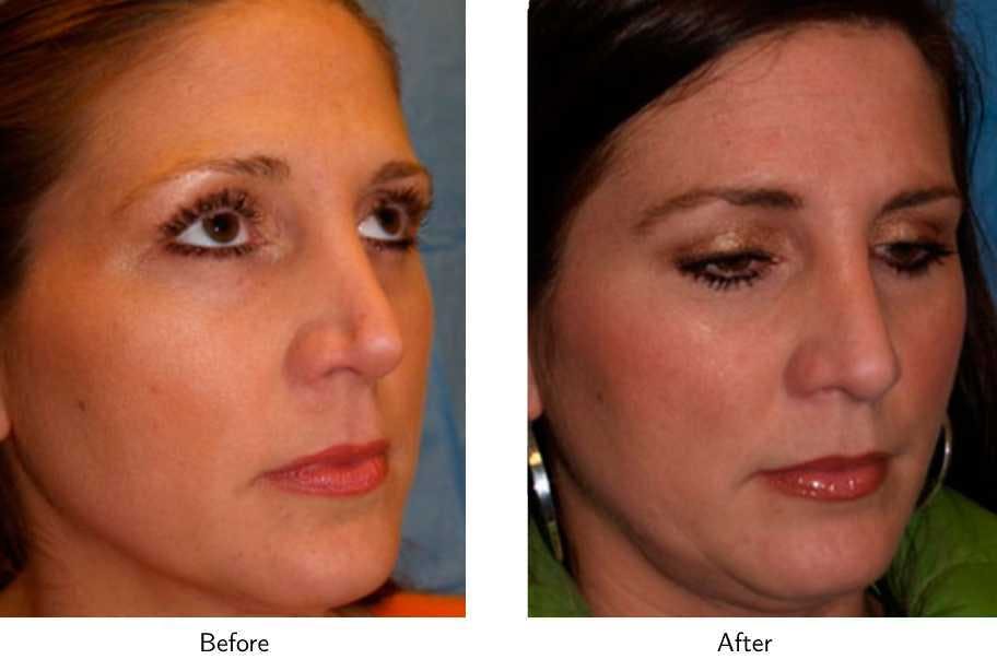 Revision Rhinoplasty Before & After Gallery - Patient 64081005 - Image 3
