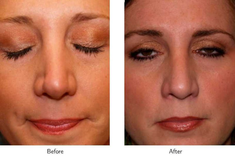 Revision Rhinoplasty Before & After Gallery - Patient 64081005 - Image 1