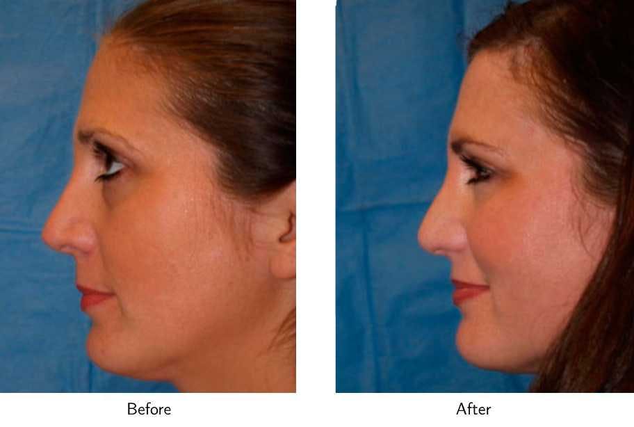 Revision Rhinoplasty Before & After Gallery - Patient 64081005 - Image 2