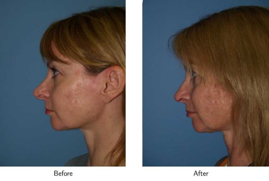 Revision Rhinoplasty Before & After Gallery - Patient 64081007 - Image 2