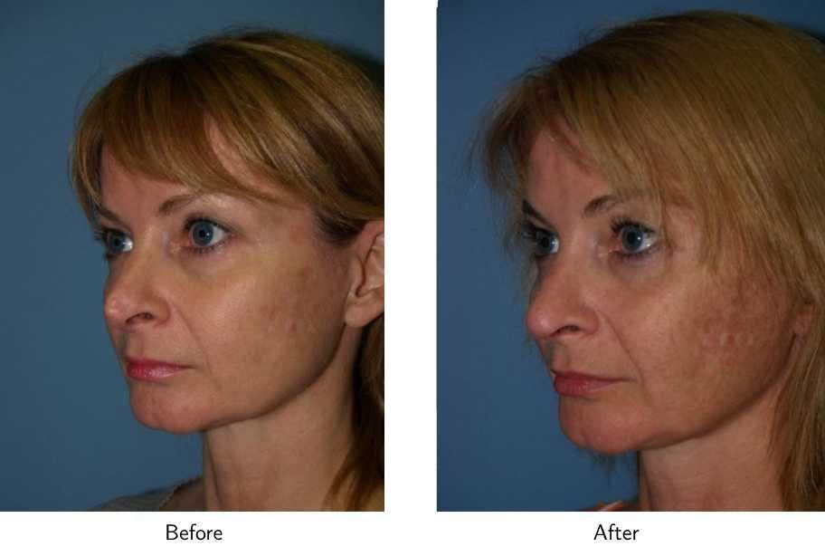 Revision Rhinoplasty Before & After Gallery - Patient 64081007 - Image 3