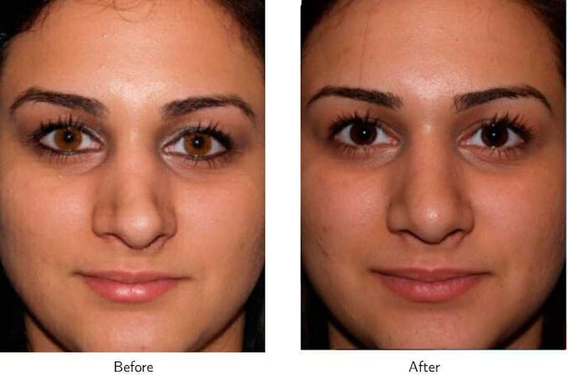 Revision Rhinoplasty Before & After Gallery - Patient 64081008 - Image 1