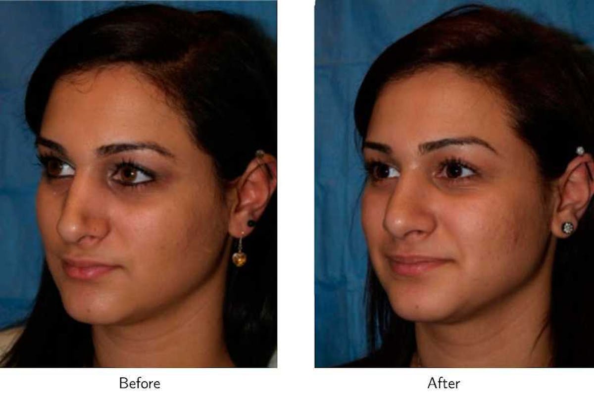 Revision Rhinoplasty Before & After Gallery - Patient 64081008 - Image 3