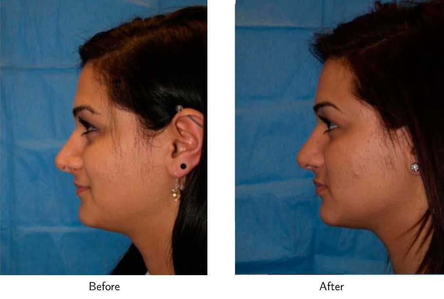 Revision Rhinoplasty Before & After Gallery - Patient 64081008 - Image 2