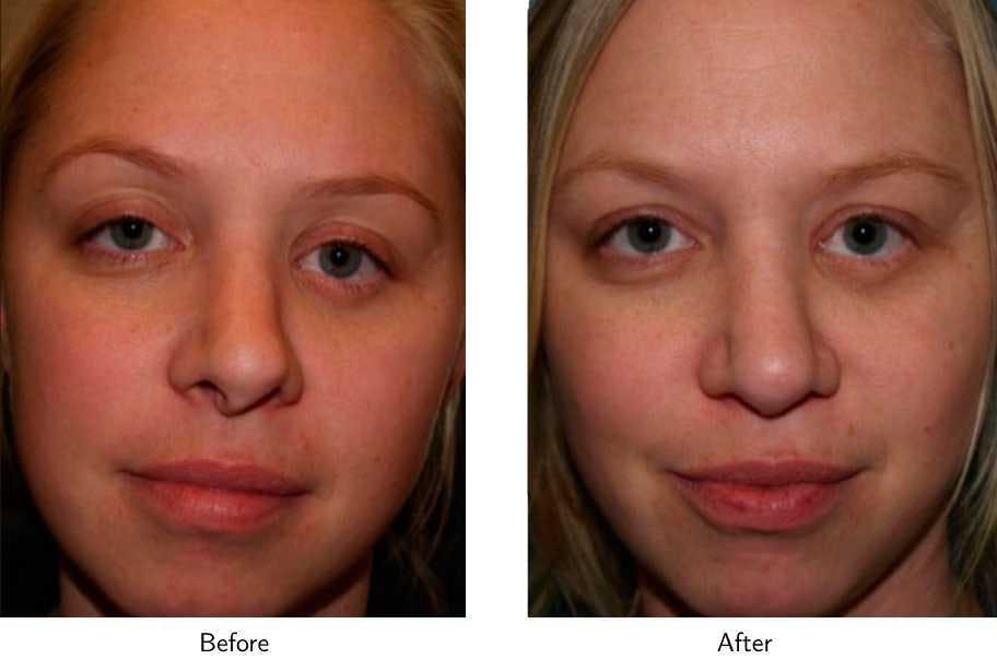 Revision Rhinoplasty Before & After Gallery - Patient 64081010 - Image 1