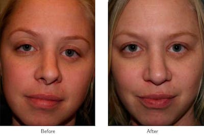 Revision Rhinoplasty Before & After Gallery - Patient 64081010 - Image 1