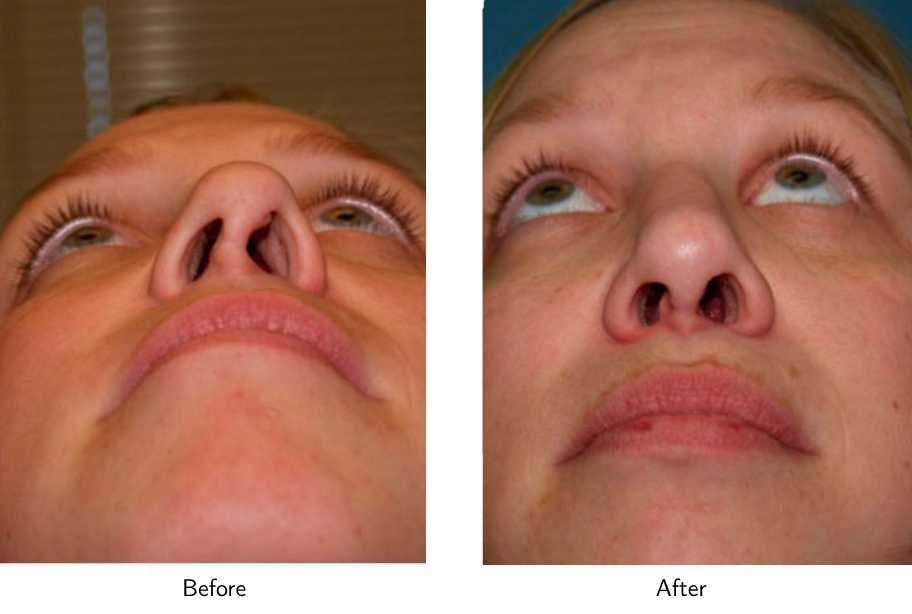 Revision Rhinoplasty Before & After Gallery - Patient 64081010 - Image 3