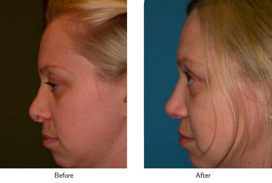 Revision Rhinoplasty Before & After Gallery - Patient 64081010 - Image 2