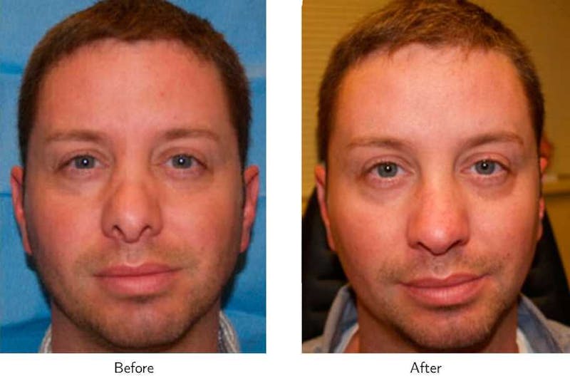 Revision Rhinoplasty Before & After Gallery - Patient 64081011 - Image 1