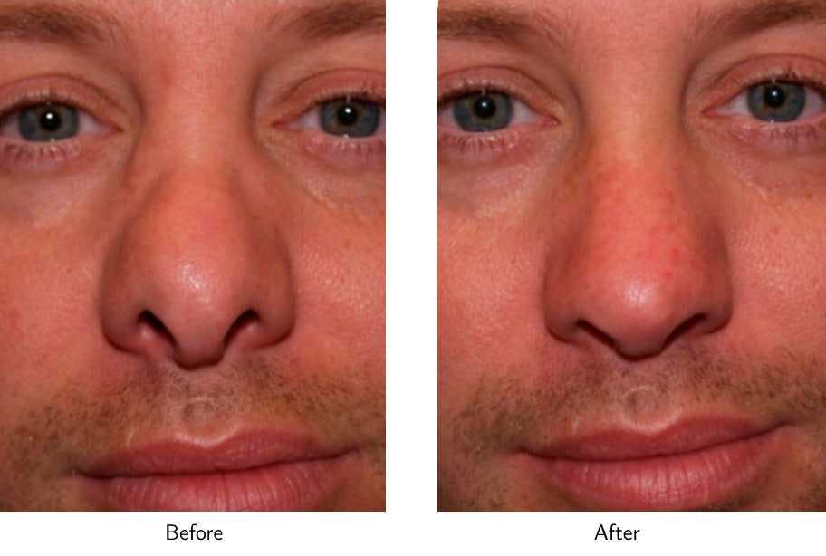 Revision Rhinoplasty Before & After Gallery - Patient 64081011 - Image 3