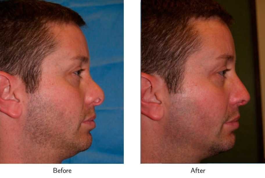 Revision Rhinoplasty Before & After Gallery - Patient 64081011 - Image 2