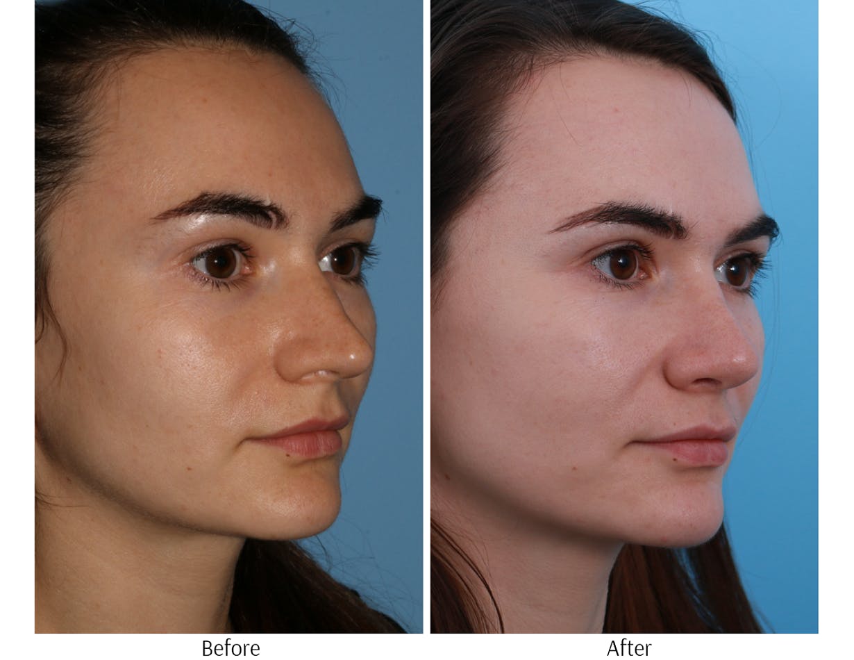 Rhinoplasty Before & After Gallery - Patient 64081018 - Image 2