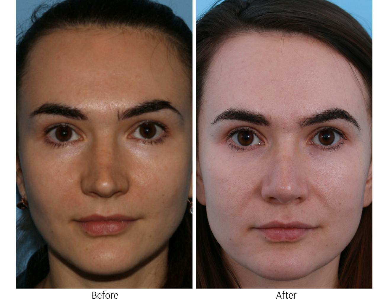 Rhinoplasty Before & After Gallery - Patient 64081018 - Image 3