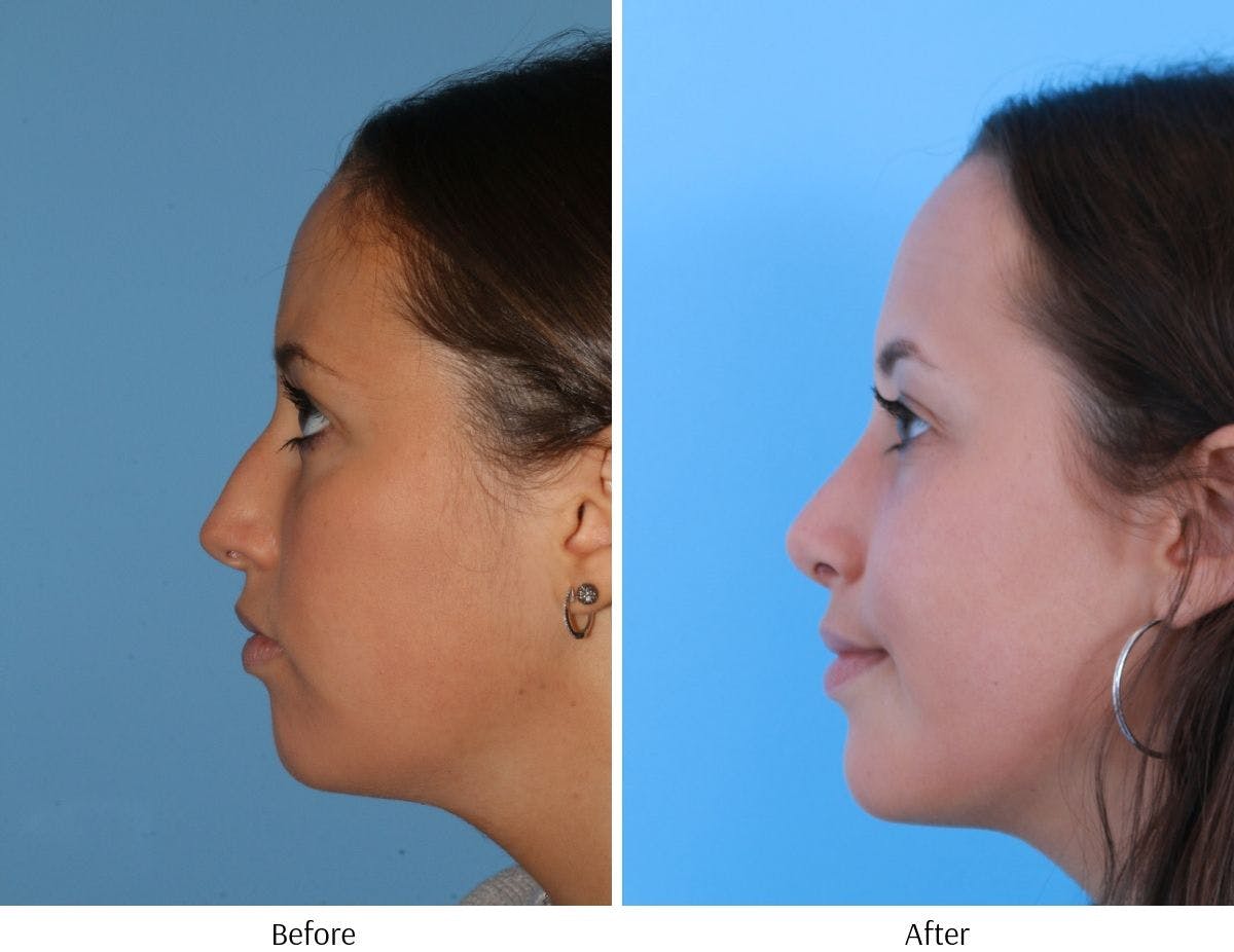 Rhinoplasty Before & After Gallery - Patient 64081019 - Image 2