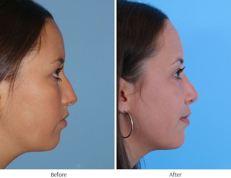 Rhinoplasty Before & After Gallery - Patient 64081019 - Image 1