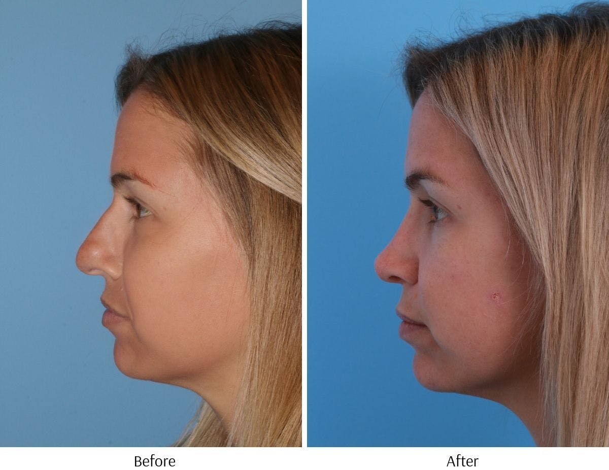 Rhinoplasty Before & After Gallery - Patient 64081020 - Image 3