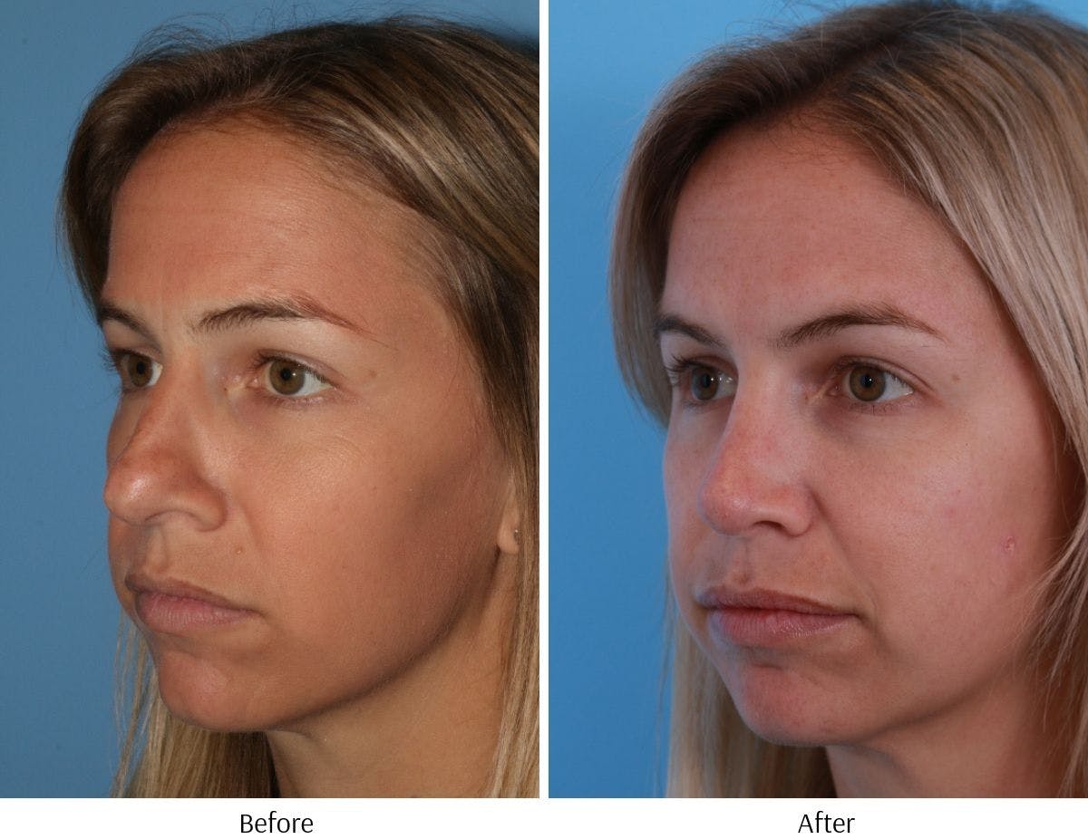 Rhinoplasty Before & After Gallery - Patient 64081020 - Image 2
