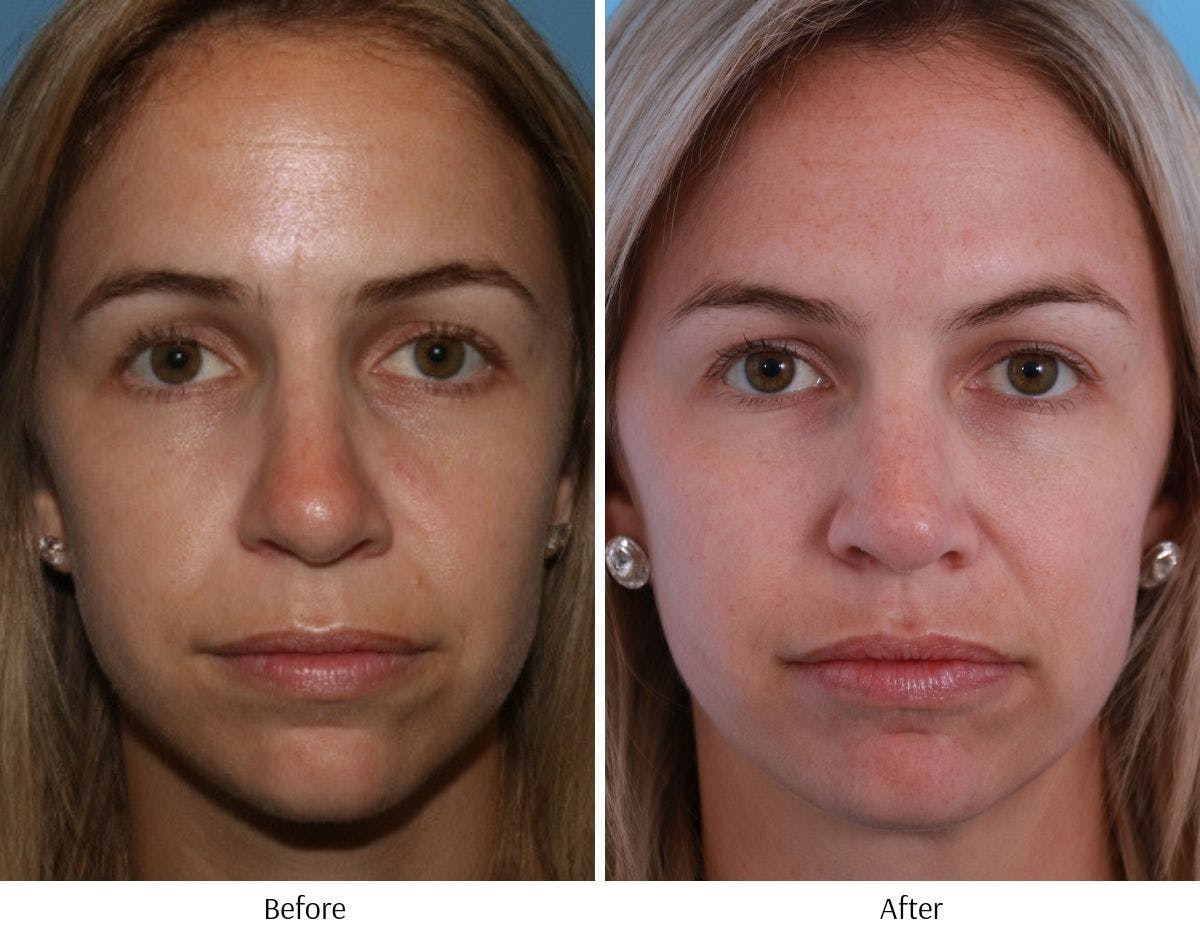 Rhinoplasty Before & After Gallery - Patient 64081020 - Image 4