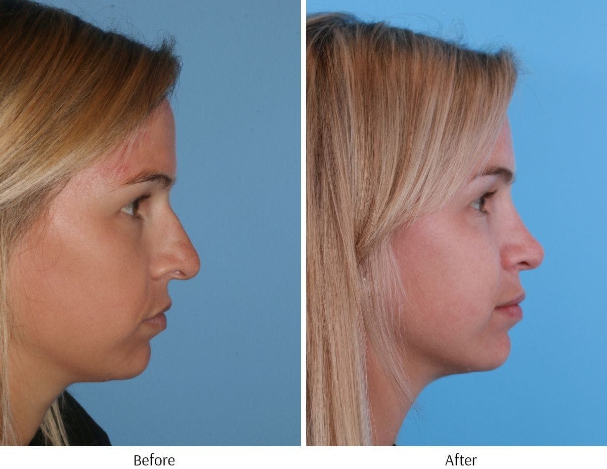 Rhinoplasty Before & After Gallery - Patient 64081020 - Image 5