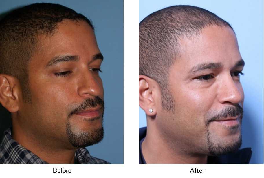Rhinoplasty Before & After Gallery - Patient 64081021 - Image 2