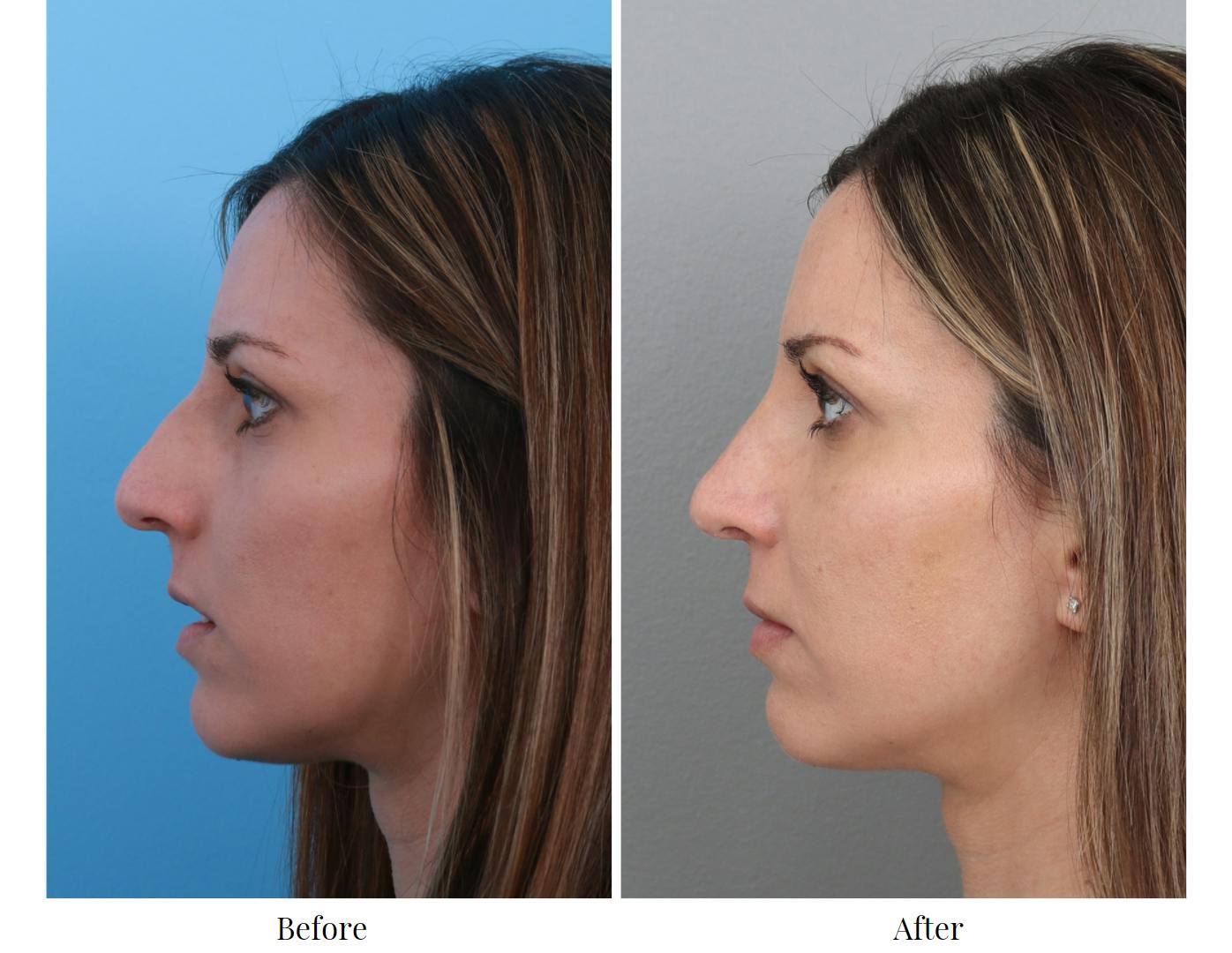 Rhinoplasty Before & After Gallery - Patient 64081023 - Image 2