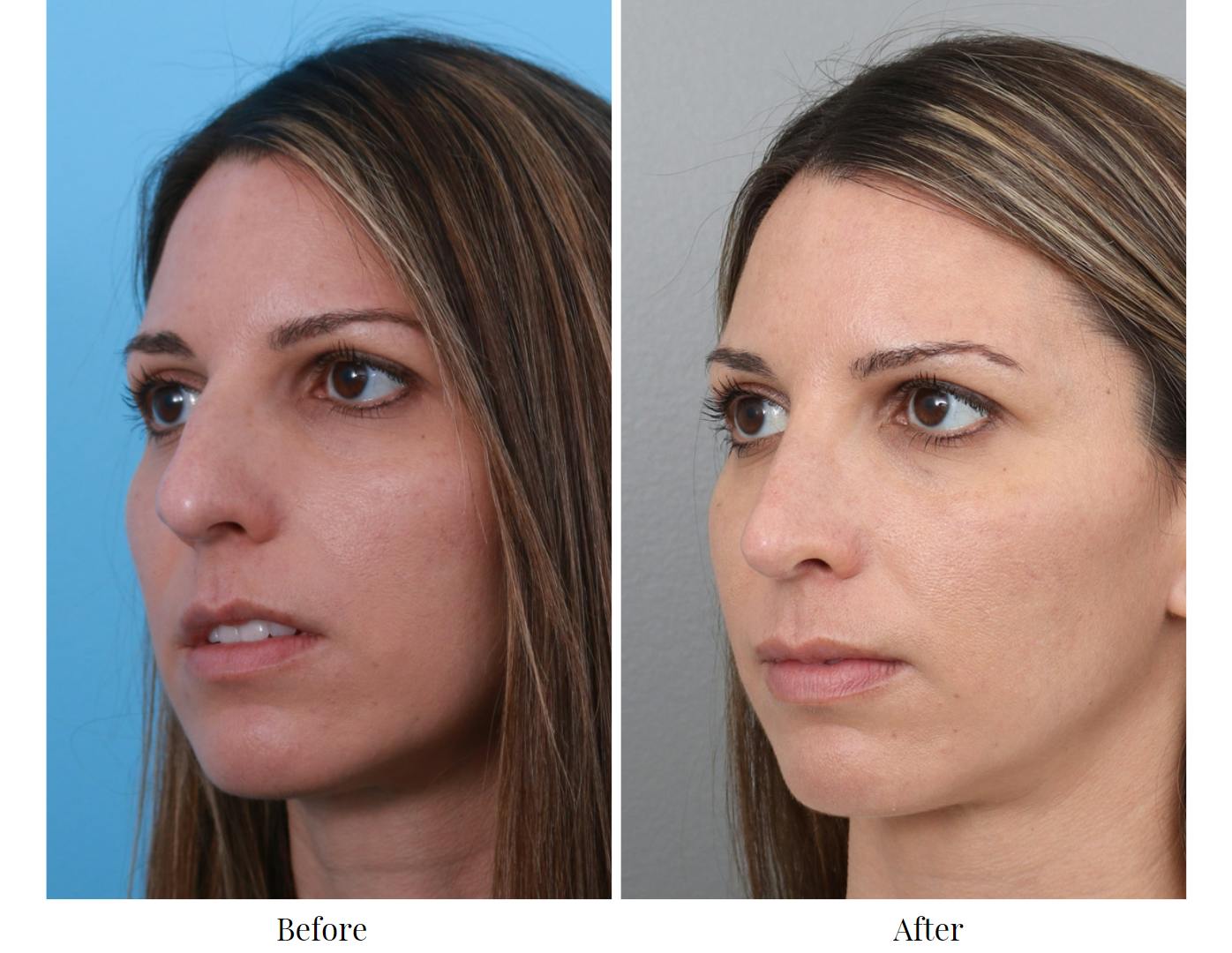 Rhinoplasty Before & After Gallery - Patient 64081023 - Image 3