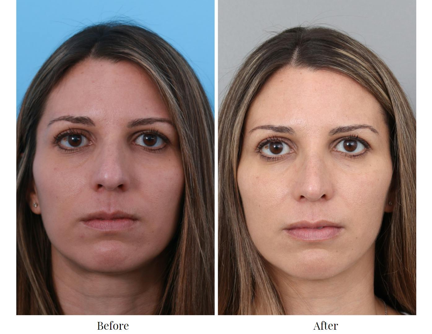 Rhinoplasty Before & After Gallery - Patient 64081023 - Image 4