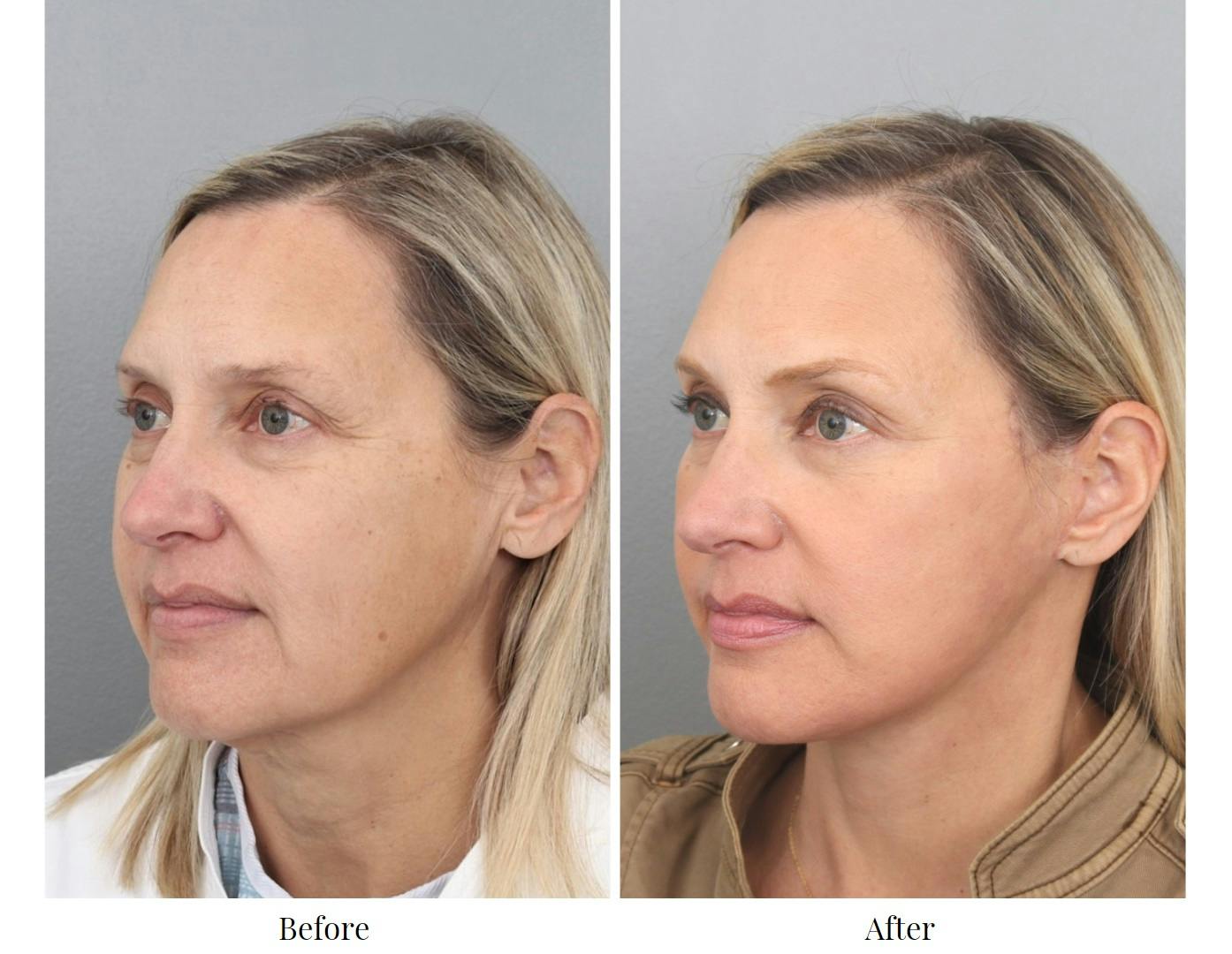 Facelift Before & After Gallery - Patient 64081022 - Image 3