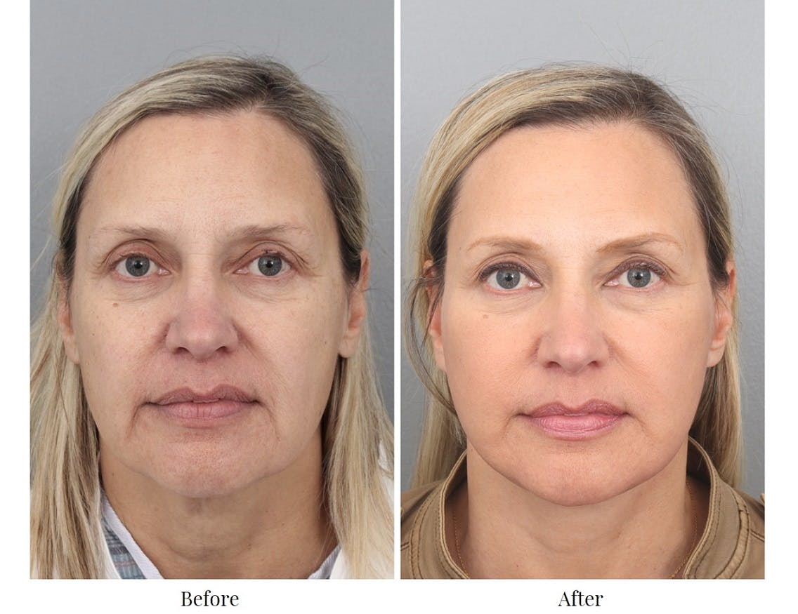 Facelift Before & After Gallery - Patient 64081022 - Image 2
