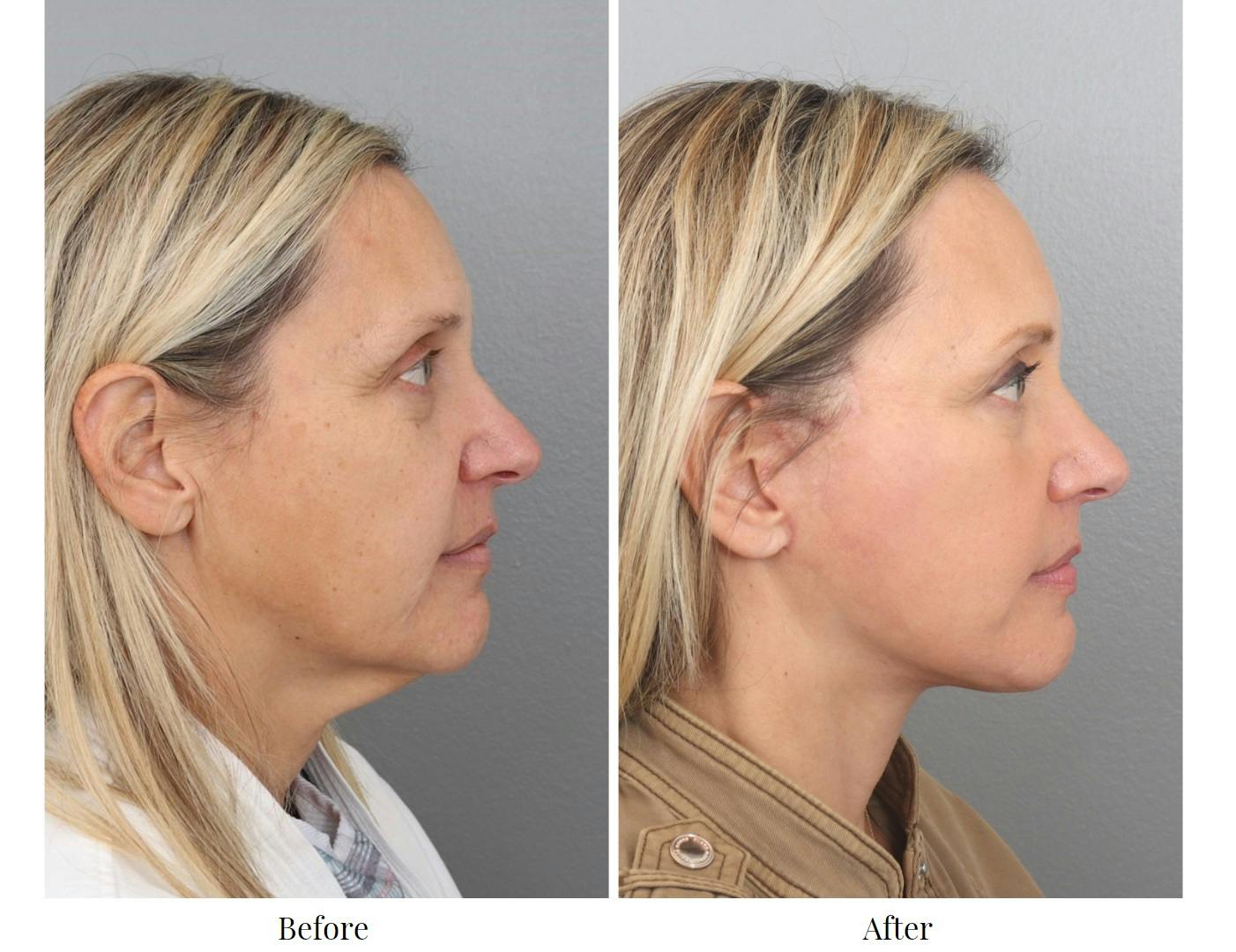 Facelift Before & After Gallery - Patient 64081022 - Image 1