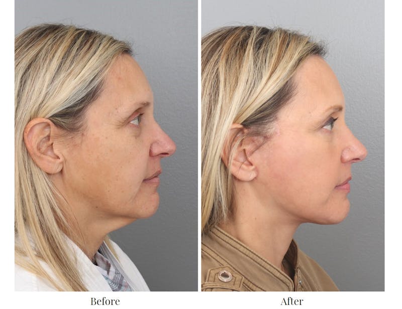 Facelift Before & After Gallery - Patient 64081022 - Image 1