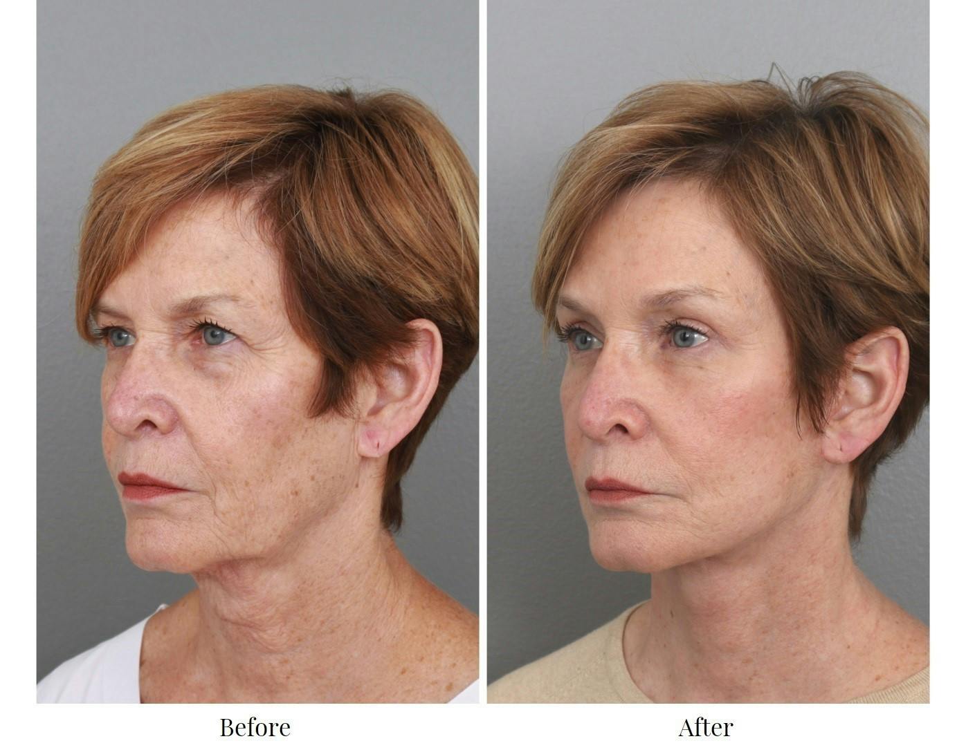 Facelift Before & After Gallery - Patient 64081025 - Image 3