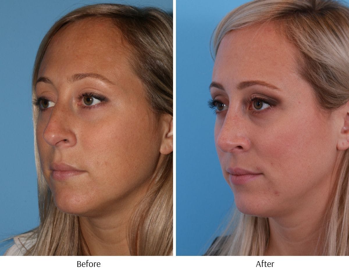 Rhinoplasty Before & After Gallery - Patient 64081024 - Image 2