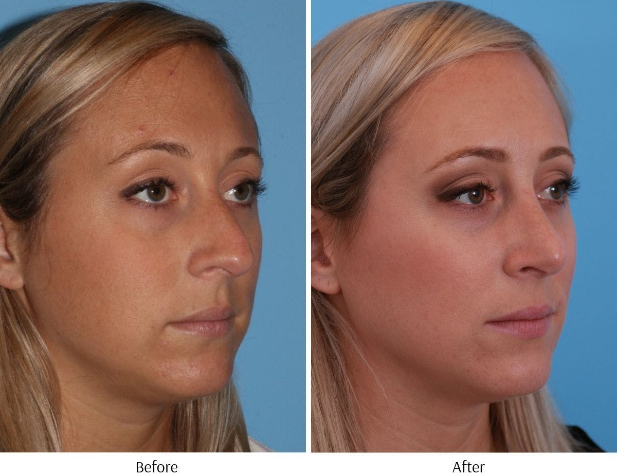 Rhinoplasty Before & After Gallery - Patient 64081024 - Image 3