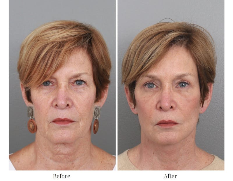 Facelift Before & After Gallery - Patient 64081025 - Image 1