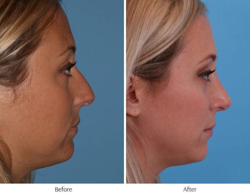 Rhinoplasty Before & After Gallery - Patient 64081024 - Image 1