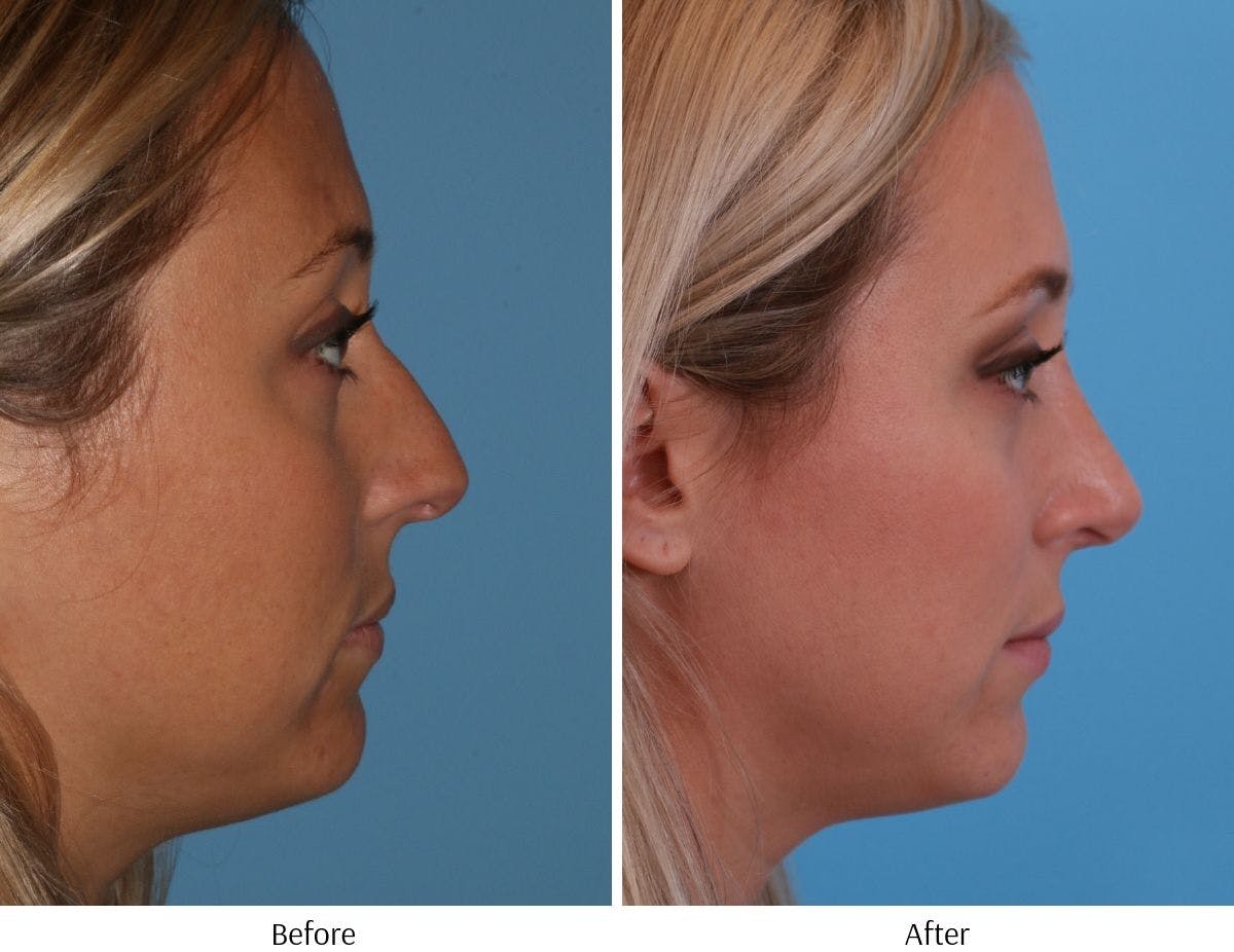 Rhinoplasty Before & After Gallery - Patient 64081024 - Image 1