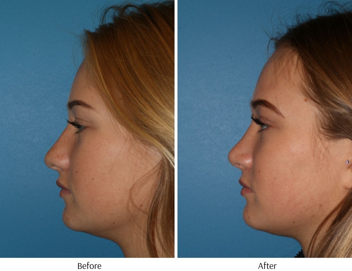 Rhinoplasty Before & After Gallery - Patient 64081026 - Image 2