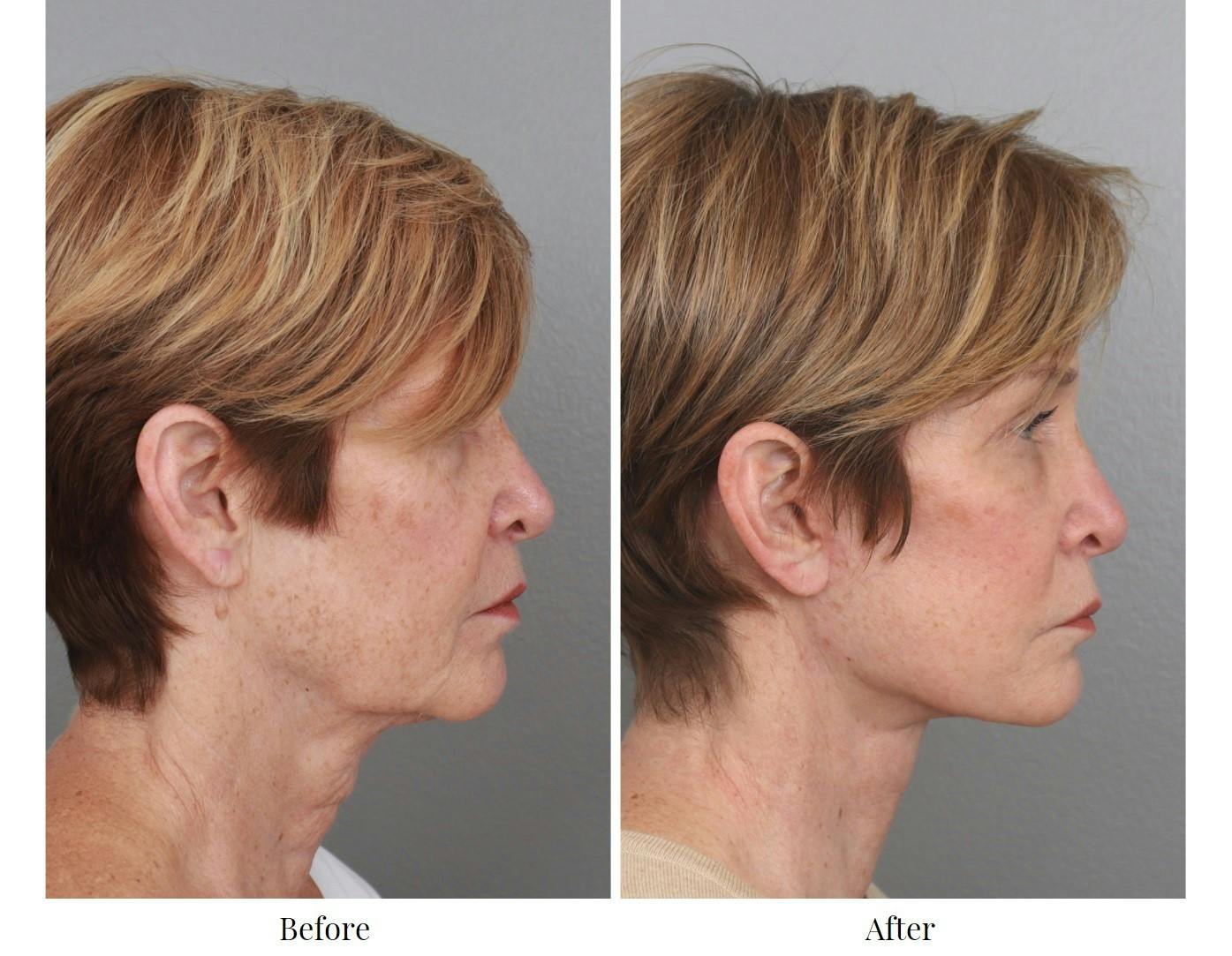 Facelift Before & After Gallery - Patient 64081025 - Image 2