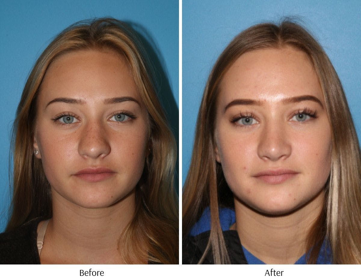 Rhinoplasty Before & After Gallery - Patient 64081026 - Image 5