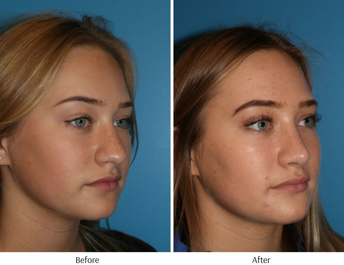 Rhinoplasty Before & After Gallery - Patient 64081026 - Image 3