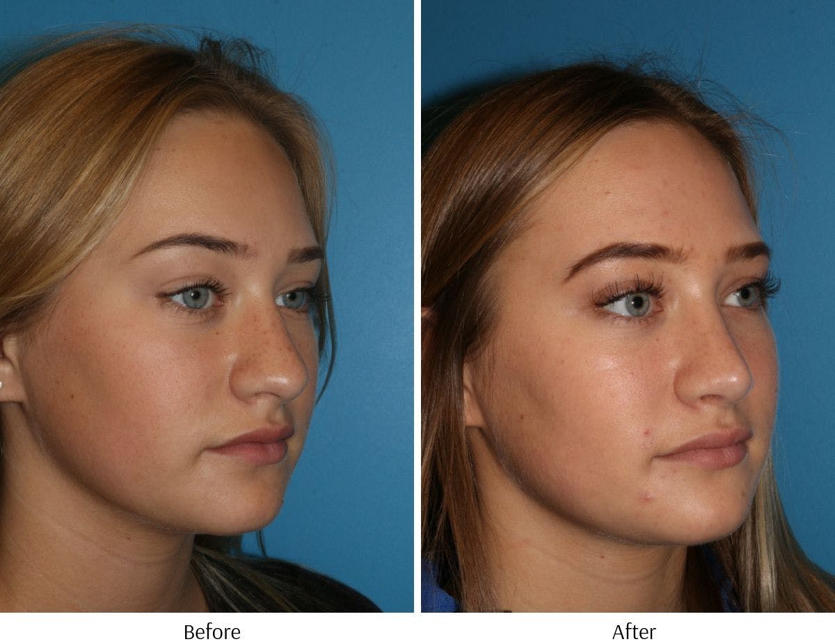 Rhinoplasty Before & After Gallery - Patient 64081026 - Image 4