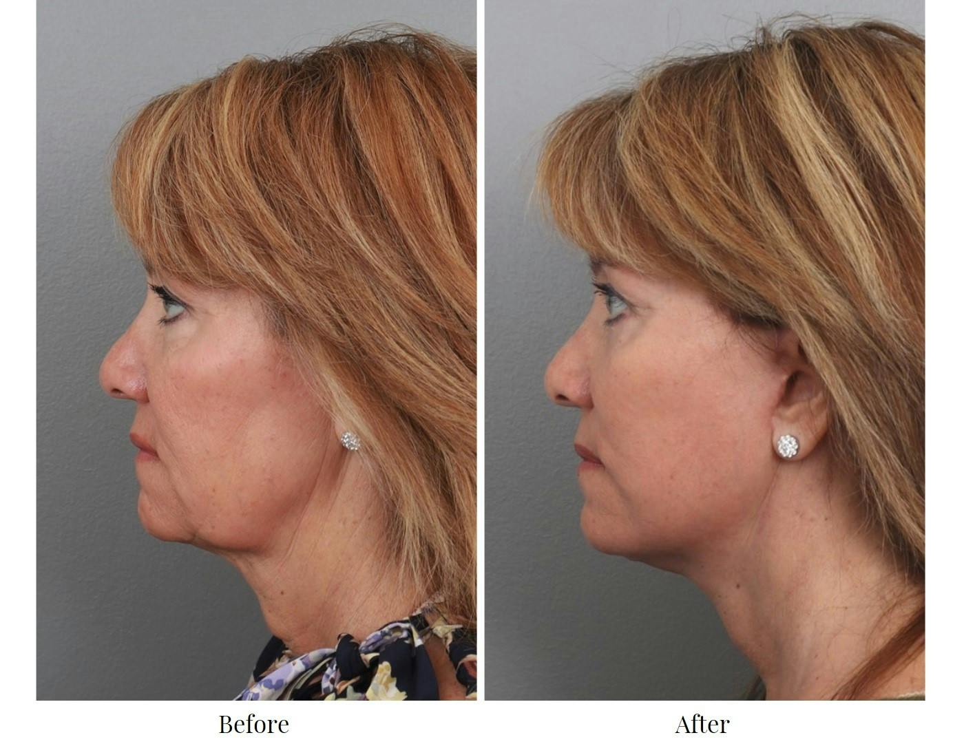 Facelift Before & After Gallery - Patient 64081030 - Image 3