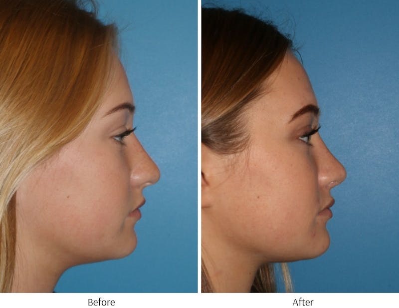 Rhinoplasty Before & After Gallery - Patient 64081026 - Image 1